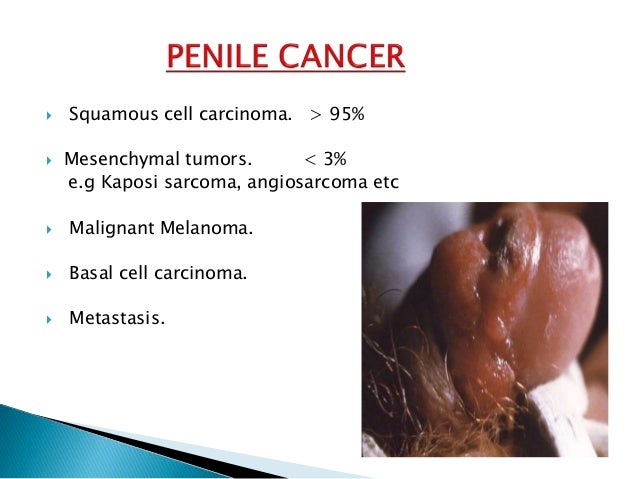 cancer of the penis Cancer of the penis